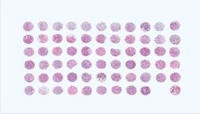 Paraffin Tissue Section Panel - Human Tumor Same Tumor Type, Different Donors (5 tissues)