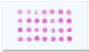 Breast Tumor Tissue Array - duplicated 70 cases covering all the common types of breast cancer and 5 cases of normal and