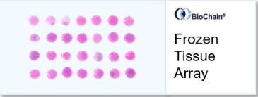 Frozen Tissue Array