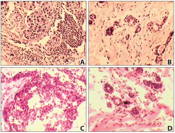 Matched Pair - Frozen Tissue Section - Human Primary and Matched Metastatic Tumor (PM): Breast